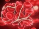 THROMBOPHILIA COMPREHENSIVE PROFILE